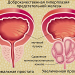 Доброкачественная гиперплазия предстательной железы и ее профилактика